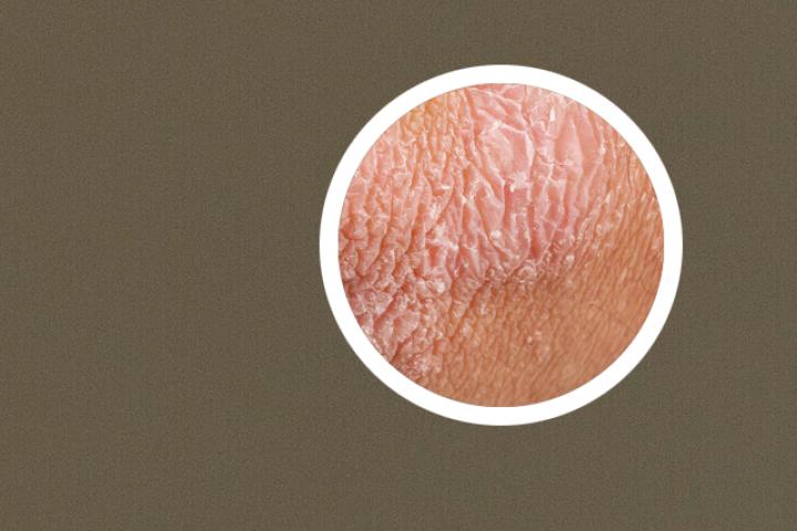 牛皮癣是慢性皮肤病吗