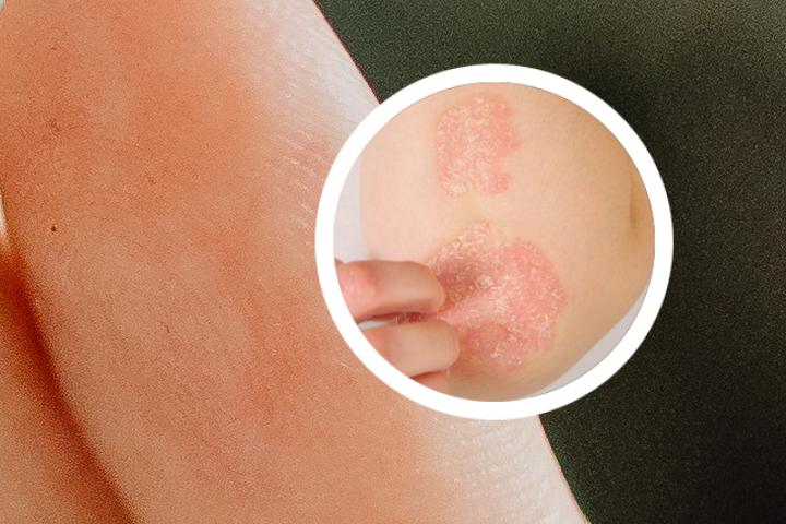 手脚上出现红疹子是不是银屑病的症状