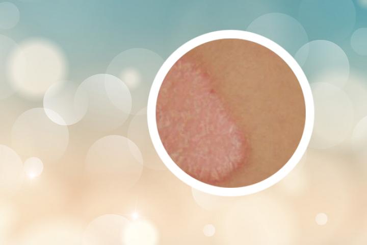 寻常型银屑病有哪些典型的皮肤损害