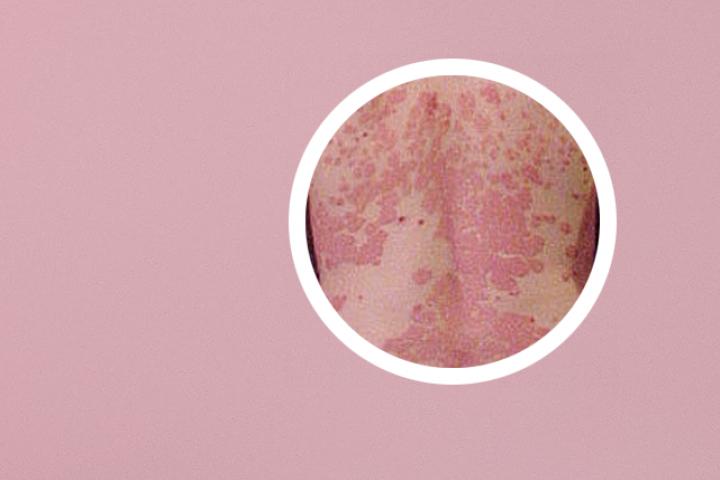 皮疹性银屑病是一种可治愈的皮肤病吗
