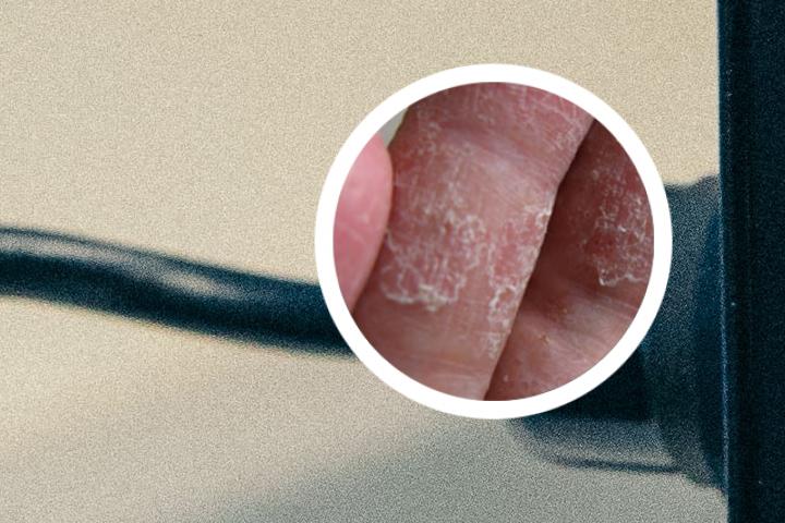 银屑病引起的指甲上的凹陷有什么治疗方法呢