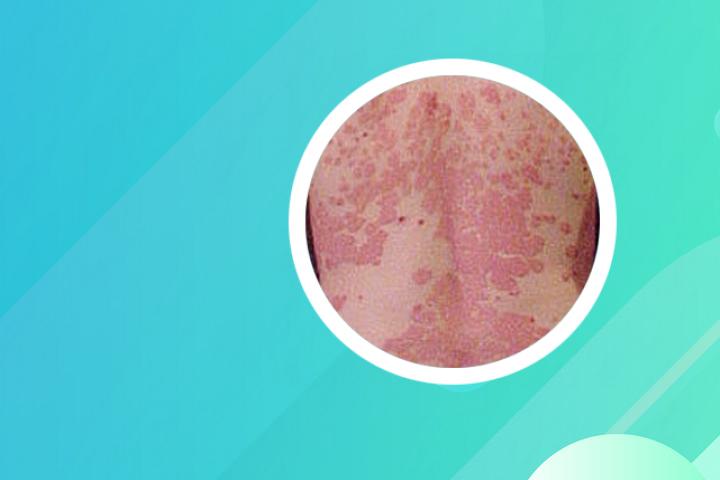 银屑病是一种常见的皮肤病吗