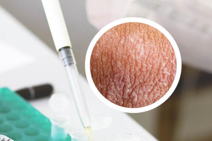 银屑病会导致什么样的皮肤问题呢