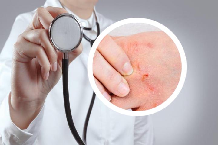 患有银屑病湿疹，为什么会有大量的皮屑脱落