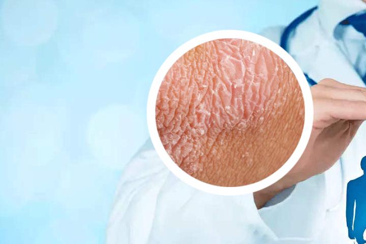 有一种皮肤病类似银屑病，但不易刮掉吗