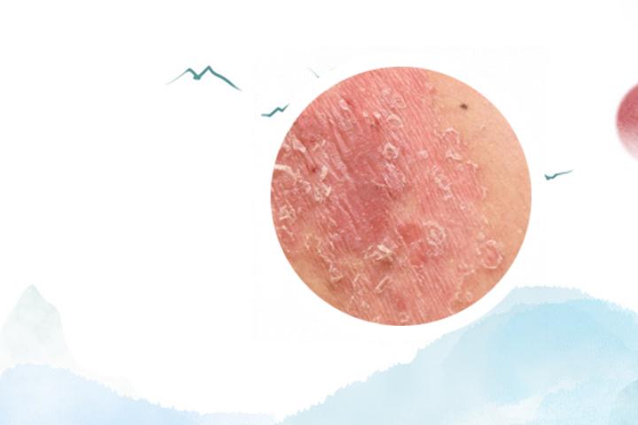 银屑病导致皮肤瘙痒有鸡皮疙瘩的症状，怎样缓解