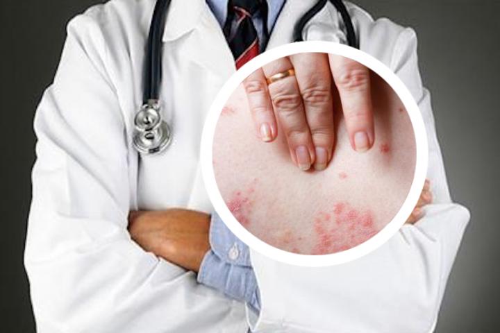 干性湿疹和副银屑病