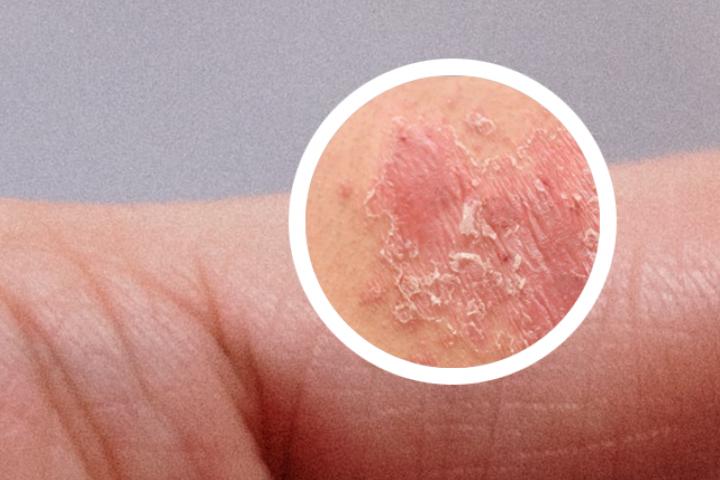 慢性湿疹诊断为银屑病