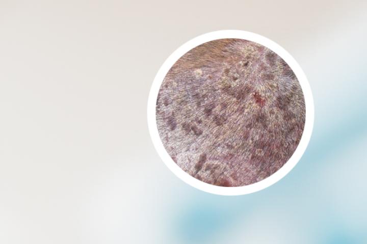 皮肤镜下银屑病结果可以确认银屑病的诊断吗