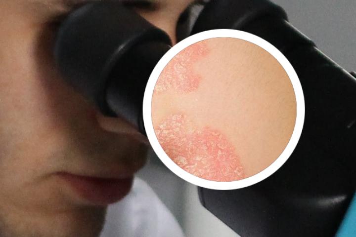 脓疱型银屑病为什么会导致皮肤肿痛