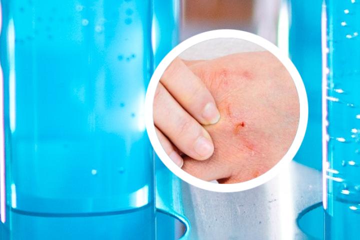指甲银屑病是否具有遗传性