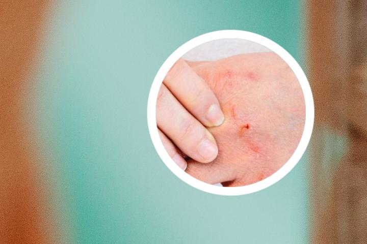 指甲湿疹与甲银屑病