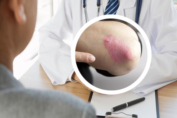 银屑病的皮损什么时候会好转，会出现红色疹吗