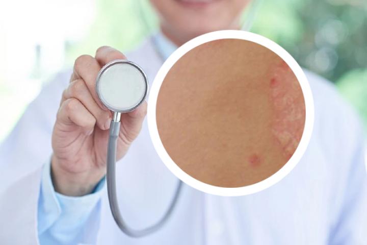 我皮肤上出现了红斑疹，不知道是梅毒疹还是银屑病