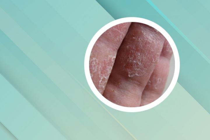 指甲银屑病与灰指甲有什么区别
