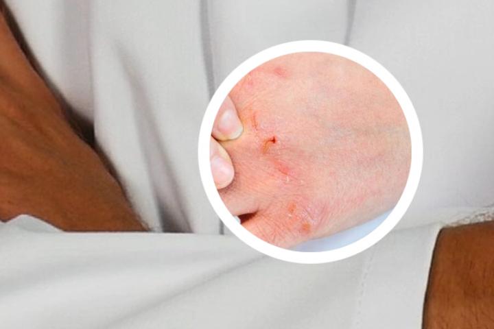 红斑丘疹鳞屑型银屑病是什么