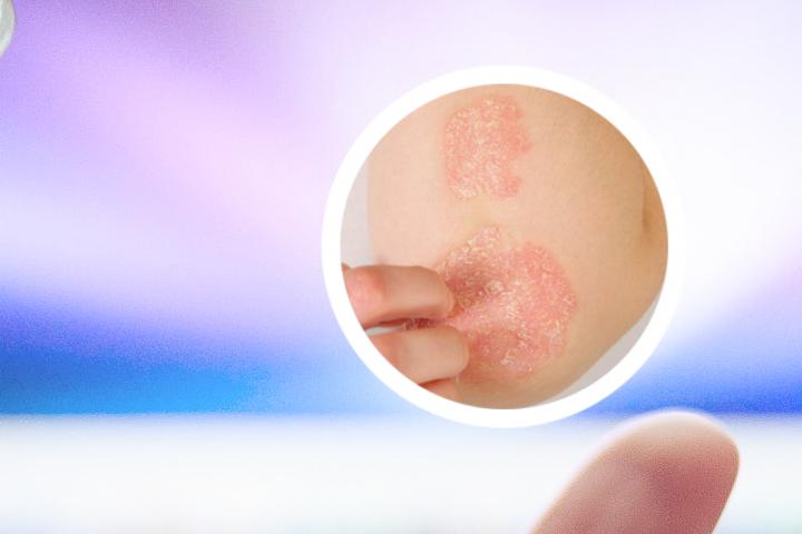 银屑病指甲前沿发黄，是什么原因导致的呢