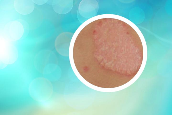 银屑病消退期皮疹发红是什么症状