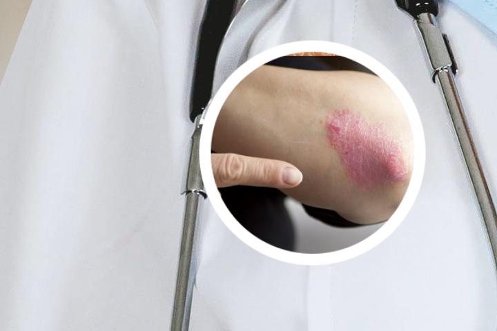 指甲出现化脓是银屑病的常见症状吗