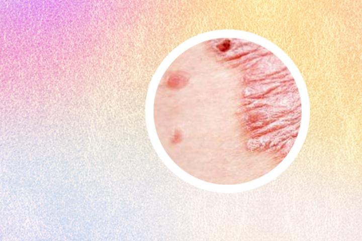 儿童患有皮癣的时候会被误诊为银屑病吗