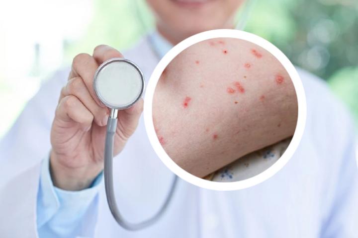 荨麻疹和牛皮癣哪个更痒