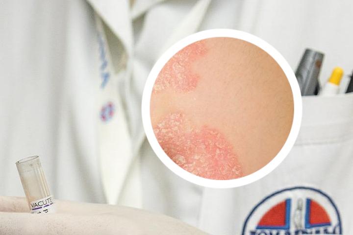 怎么判断湿疹与银屑病