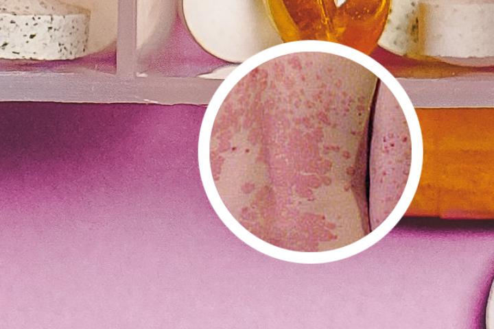红皮型银屑病干裂起皮有哪些症状