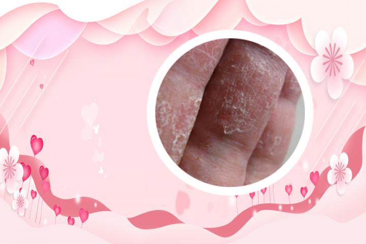 银屑病指甲变形的症状是什么
