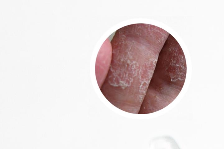 银屑病为何会特别痒且皮肤异常红肿