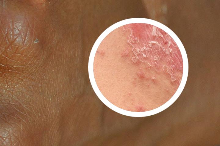为什么红皮病型银屑病会出现水肿症状