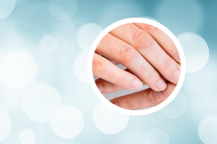 我手指出现了银屑病的症状，这是手指银屑病吗