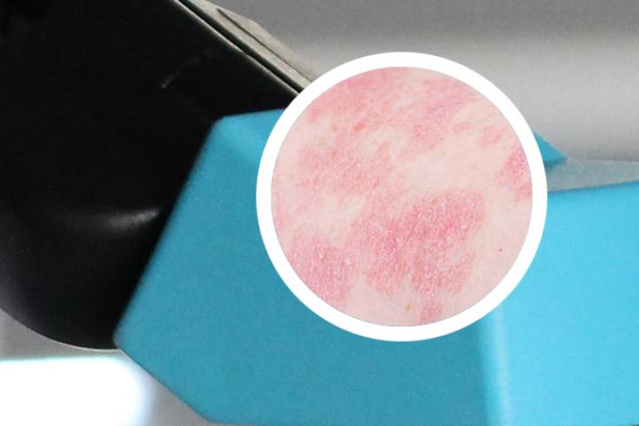 红斑银屑病会引起皮肤干裂痛吗