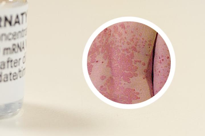 湿疹被误认为银屑病，如何区分