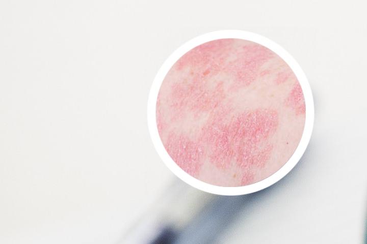 银屑病能通过皮肤镜检查来确诊吗