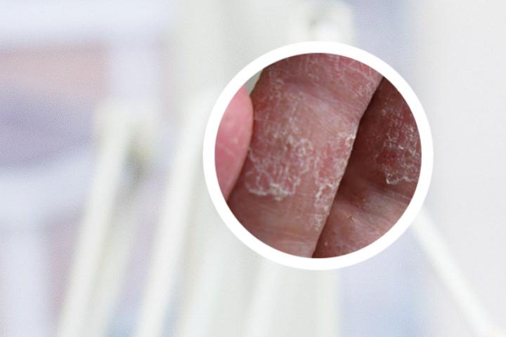 角化湿疹和银屑病有什么区别