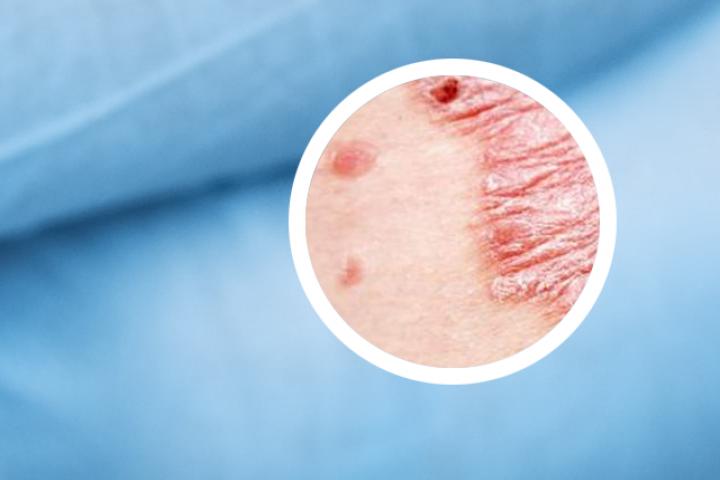 湿疹和银屑病皮肤结痂如何处理