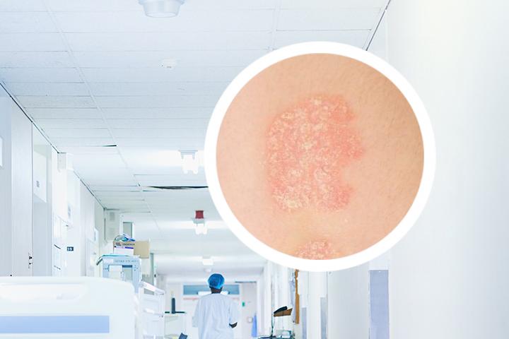 湿疹和牛皮癣是一种病吗