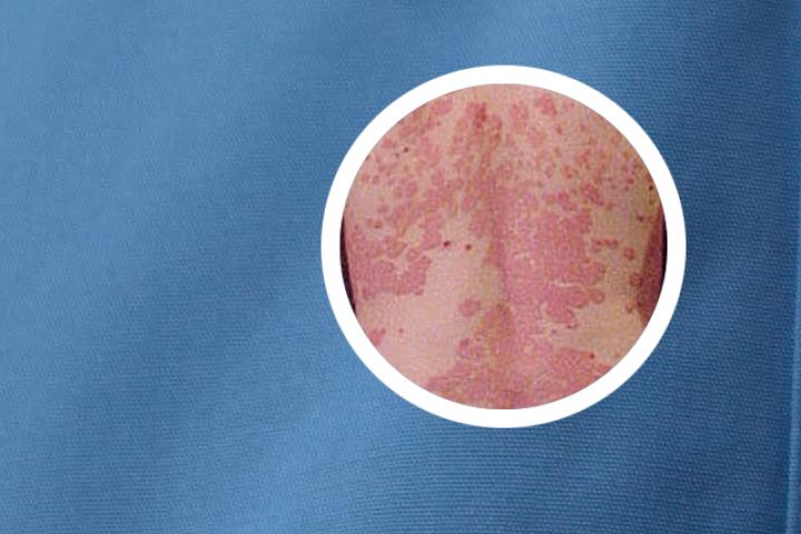 银屑病湿疹倪海厦是一种什么类型的皮肤病