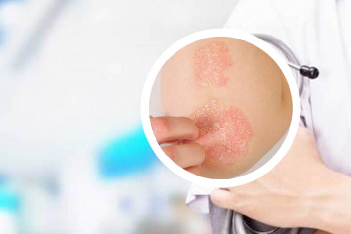 日本牛皮癣湿疹膏孕妇能用吗