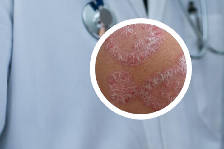 银屑病是一种普遍的皮肤病吗
