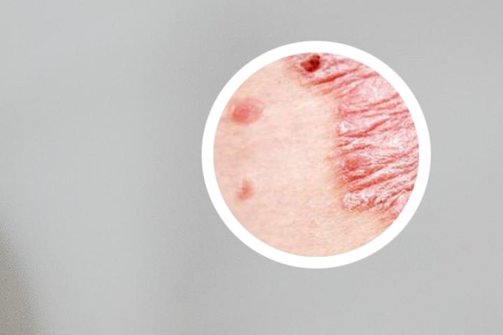 银屑病的皮肤CT能否确诊银屑病