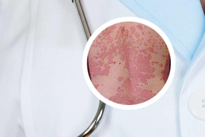 肝炎牛皮癣能治愈吗