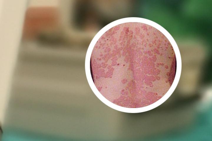 银屑病和皮癣是同一种疾病吗