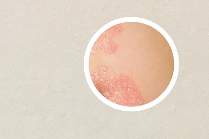 鳞屑型斑疹是不是银屑病