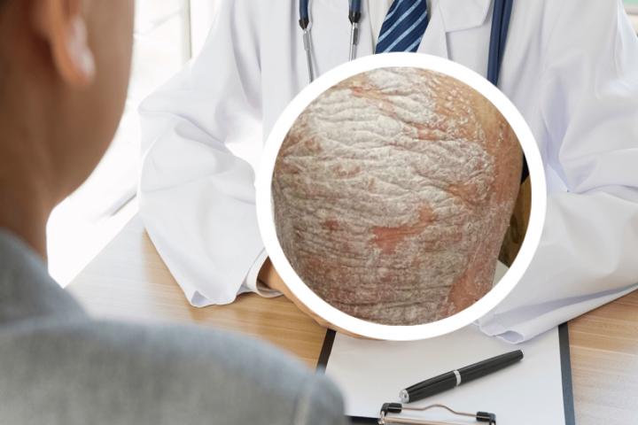 银屑病是一种发展迅速的皮肤病吗