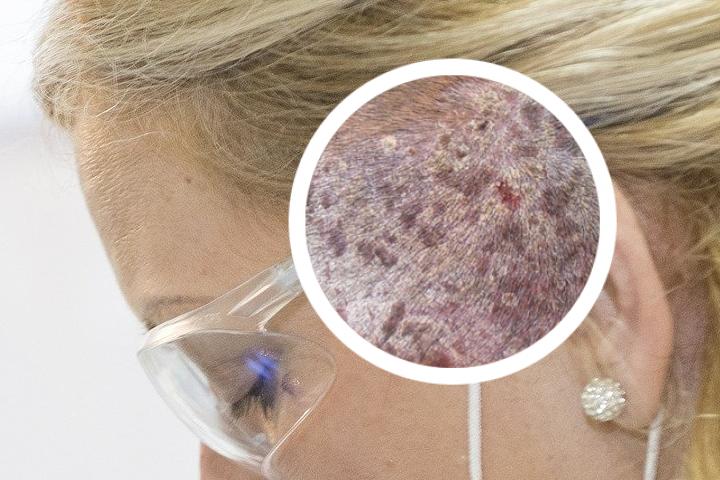 银屑病是一种常见皮肤疾病吗