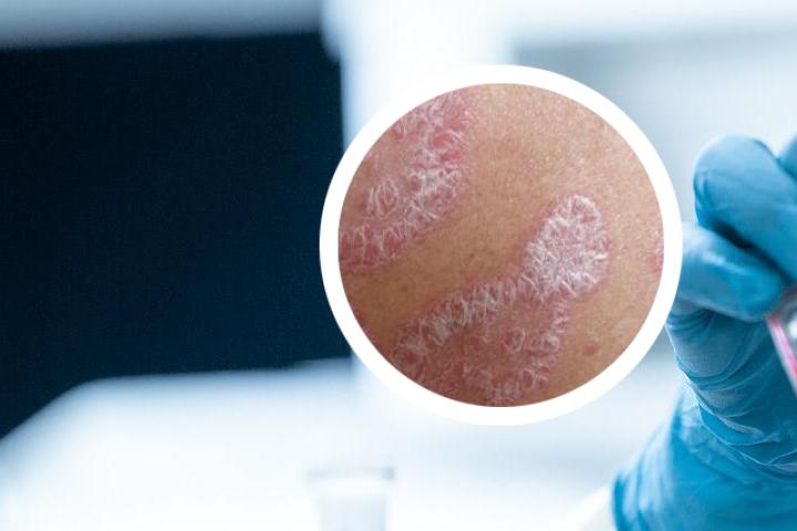 怎样区分湿疹和银屑病图片