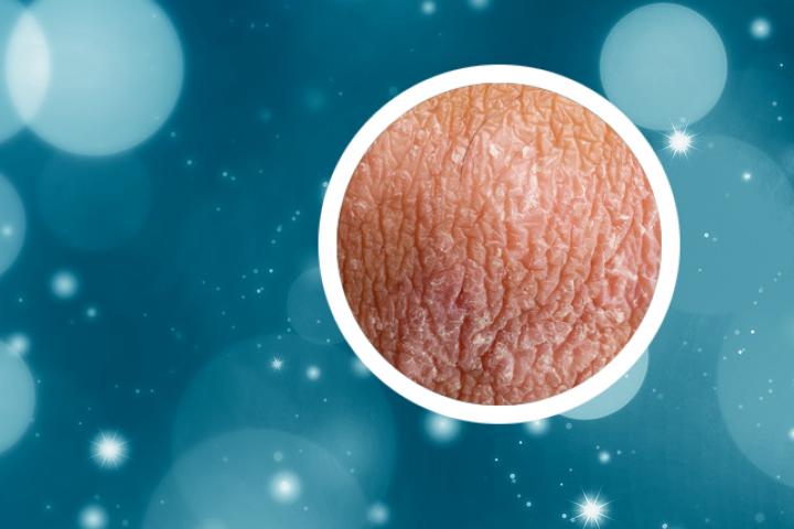 点滴型银屑病会造成什么样的皮肤症状