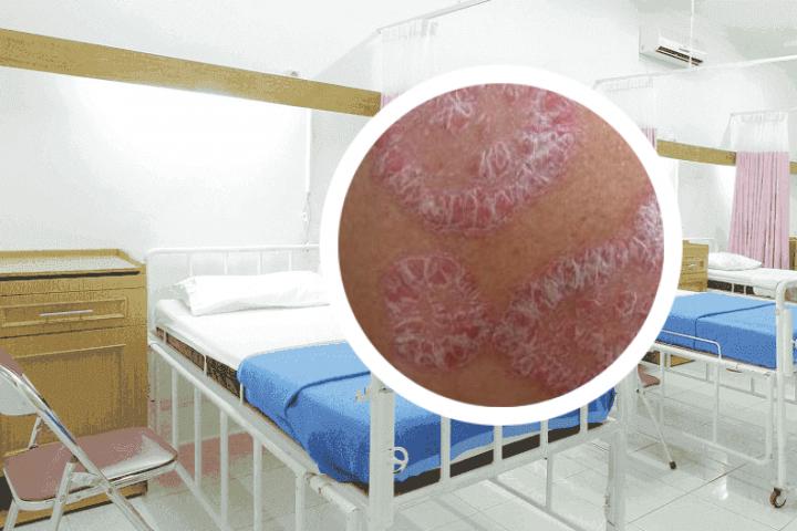 带状疱疹能转为银屑病吗