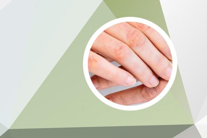 银屑病指甲缝肿是什么原因引起的
